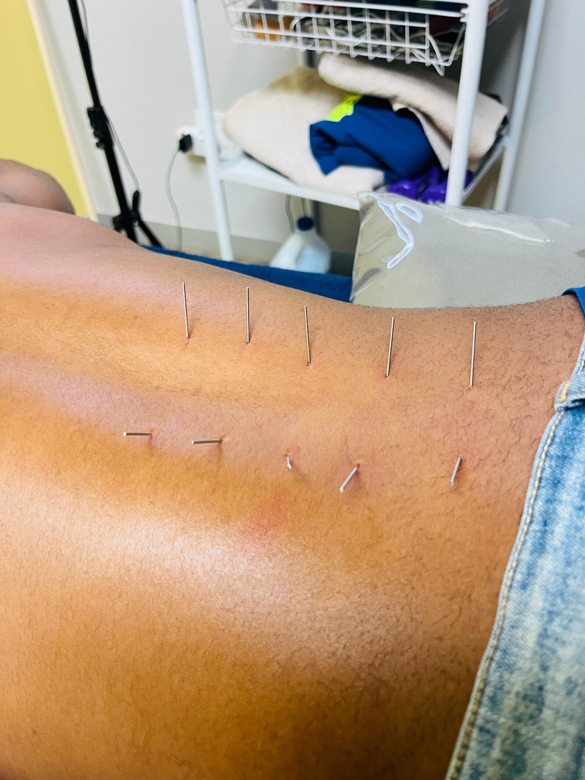 Dry needling treatment on the lower back performed by a physiotherapist to relieve muscle tension at Rabuli KP Physio.